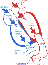 coarctatio2-T