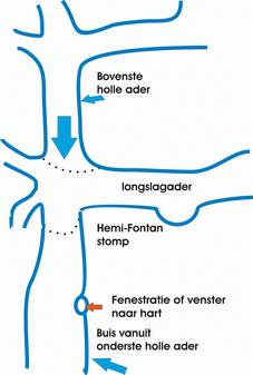 fontan-T